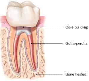 healed-tooth-root-canal