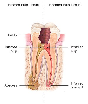 what-is-a-root-canal