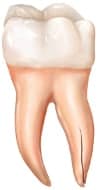 Vertical-root-fracture