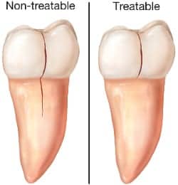cracked-teeth