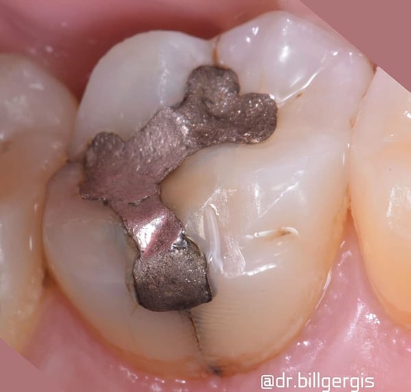 cracked-tooth
