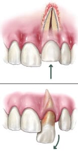 dislodged-tooth-155x300-1