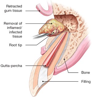 endodontic-surgery