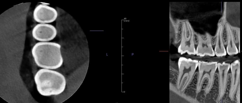 Incipient-caries-on-UR4-5-6-kissing-lesions